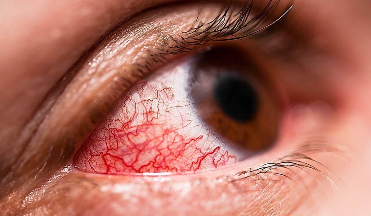 A retinopatia diabética é uma das complicações tardias do diabetes